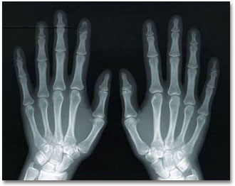 Marfan Syndrome Hands X Ray